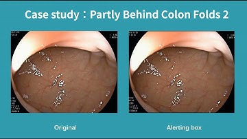 Real-Time Polyp Detection Under Partial Occlusion – Colon Folds