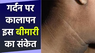 गर्दन पर भी काली लाइन दिखना इस गंभीर बीमारी का संकेत,जानिए कारण और लक्षण । Boldsky *Health screenshot 1