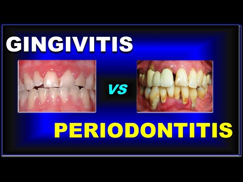 Vídeo: Com aturar el sagnat de les genives, gingivitis i periodontitis: 11 passos