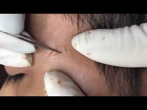 Pimple, Popping, Removing Blackheads around eyes and mouth, Bigger Blackhead , on the face, acne 