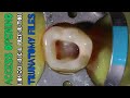 Access Opening in Mandibular Molar ⚪️ Biomechanical Preparation 🟡 TruNatomy File 🔵 Step By Step