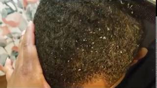 Eye Popping Dandruff 👀👀👀