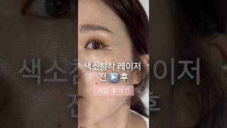 기미 주근깨 레이저 후기 피코지우개 ipl