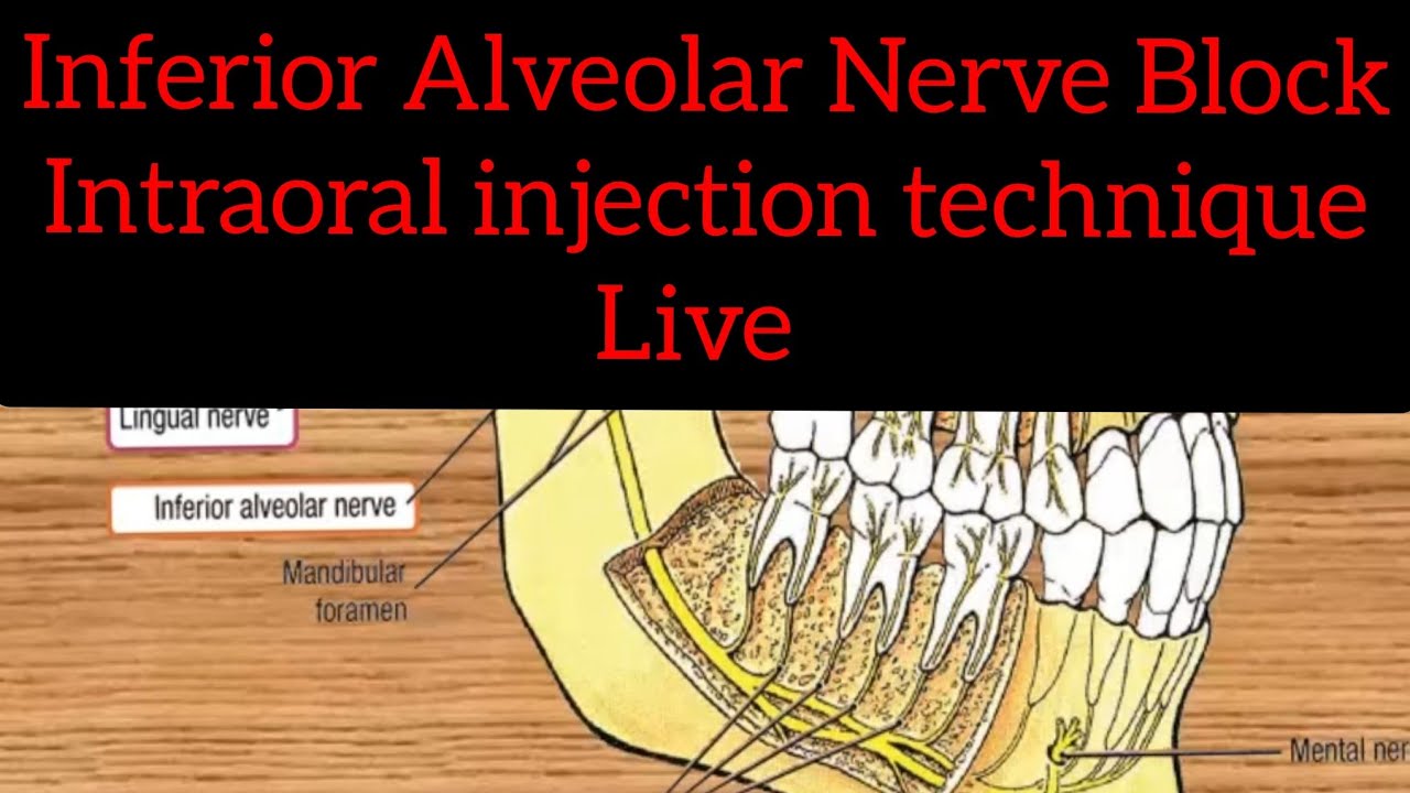 Inferior Alveolar Nerve Block IANB in adults and kids 1st Video YouTube