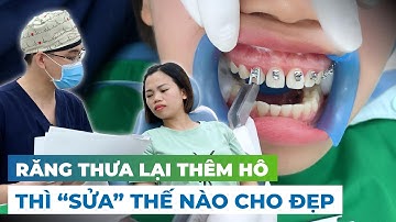 BẮT ĐẦU QUÁ TRÌNH NIỀNG RĂNG HÔ - THƯA RĂNG CỬA