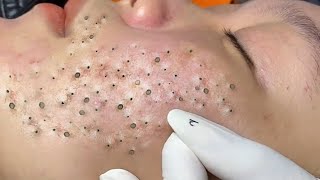 vd1 Treatment Of Blackheads And Hidden Acne