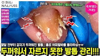몇달 전부터 갑자기 두꺼워진 발톱... 엄지는 건들지도 못했어요ㅠ 두꺼워서 자르지 못한 발톱 관리해드리기!!! #레푸스 #refuss #내성발톱 #무좀발톱 #toenails #무좀