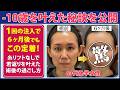 【症例解説】40代女性の脂肪注入|定着のコツは〇〇【若返り】