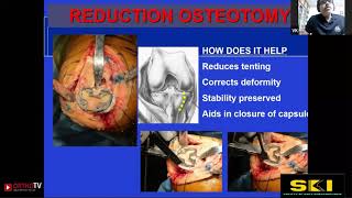 SKICON Extra: TKR IN COMPLEX KNEE DEFORMITIES Dr Parag Sancheti