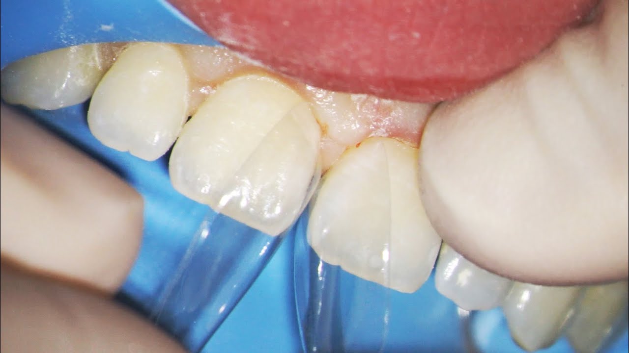 How To Get Rid Of Gaps In Teeth Diastema Closure Options