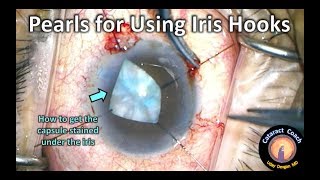 Sometimes Iris Hooks are the best approach to small pupil Cataract Surgery