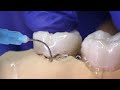 How to Use PERIO-FLUSH? Periodontal Pocket Irrigation