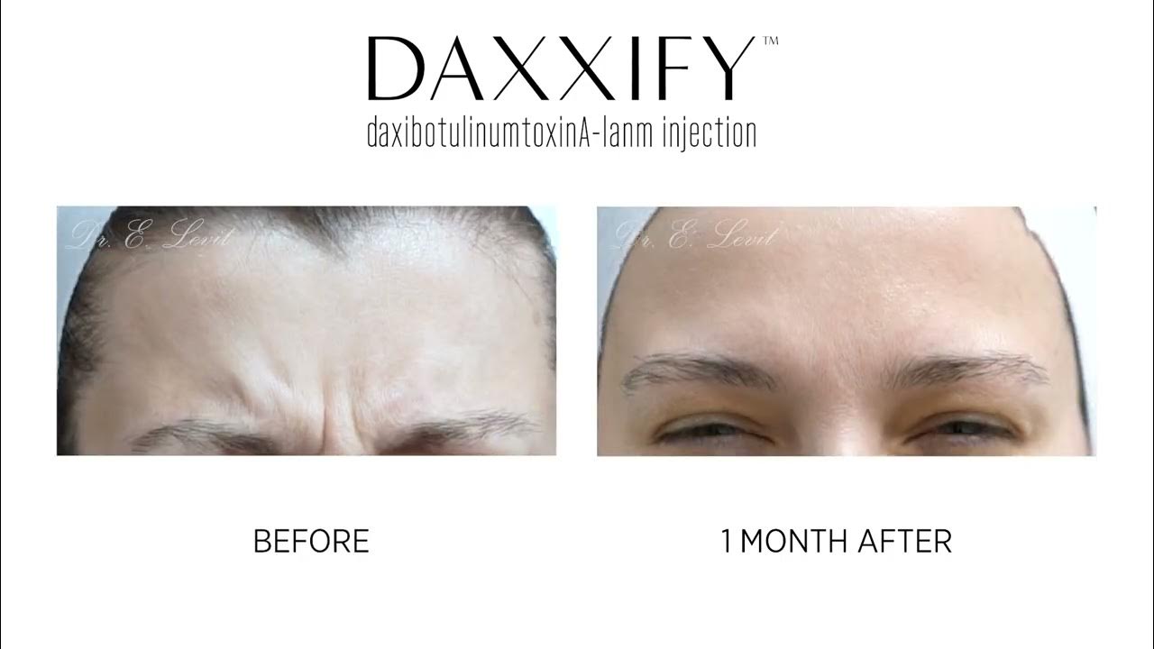 DAXXIFY. The longlasting frown line treatment. YouTube