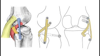 Posterolateral Corner of Knee: Repair Vs Reconstruction