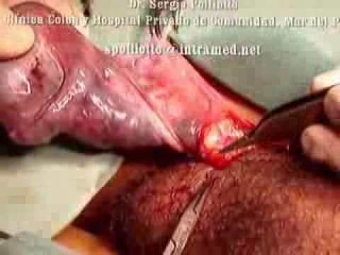 Video: Dolor Testis: Sebab, Komplikasi Dan Tratamiento