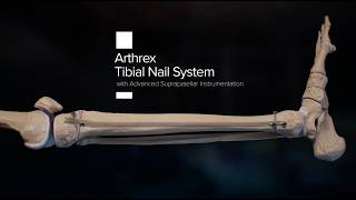 Arthrex Tibial Nail System: Features and Benefits