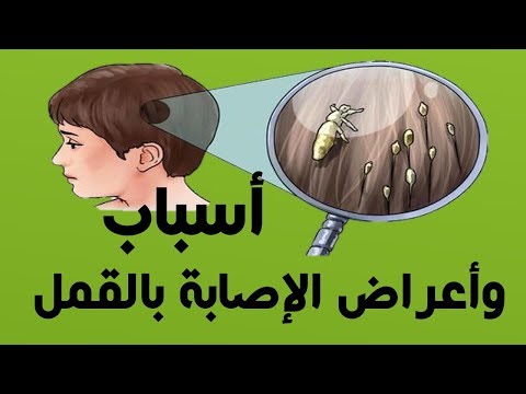 هذه هي أسباب ظهور قمل شعر الرأس وخاصة عند الأطفال وأعراض الإصابة بالقمل