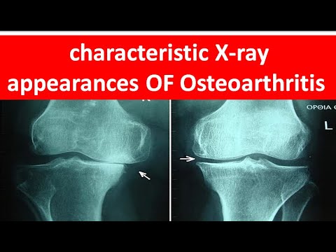 How to diagnose Osteoarthritis by xray