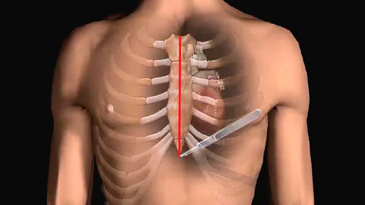 How Does Heart Bypass Surgery Work? Coronary Artery Bypass Graft Procedure Animation - CABG Video - DayDayNews