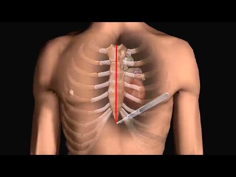 How Does Heart Bypass Surgery Work? Coronary Artery Bypass Graft Procedure Animation - CABG Video