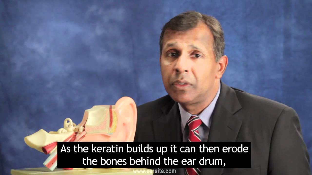 Cholesteatoma from a Tympanic Perforation with Subtitles YouTube