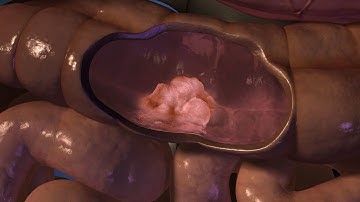 Clonal diversity in tumors