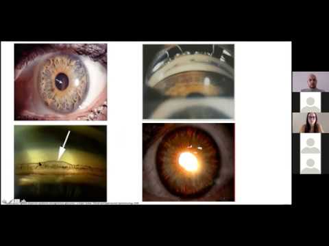 Sindrome de dispersión pigmentaria y Glaucoma pigmentario