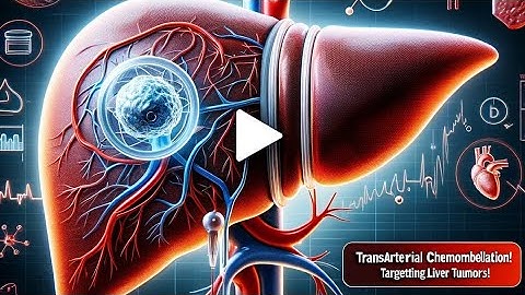 TACE | Trans-arterial chemo-embolization | Chemotherapy | Cancer Treatment | Dr. Gaurav Gangwani
