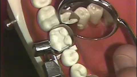 Packing of Class II Amalgam for Hygienists