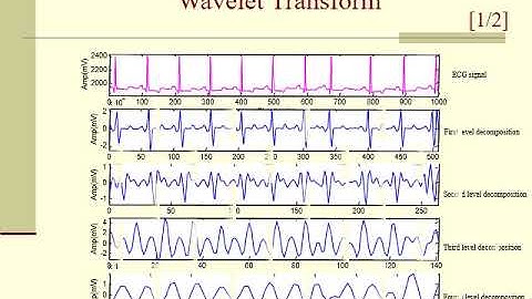 ECG Arrhythmia Classification using Support Vector Machine (SVM) | ECG