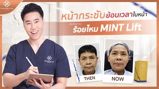 คุณหมอเซนท์เผยเคล็ดลับ หน้าเด้ง ตึงกระชับด้วยการร้อยไหม MINT Lift ลดอายุใบหน้าได้จริง #ร้อยไหม