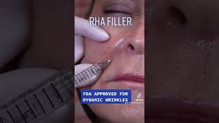 Reversing the Signs of Aging with RHA Filler