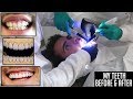 My Teeth Before & After (Laser Gum Surgery & Veneers)