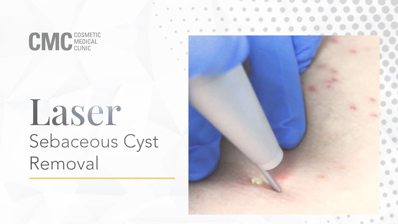 Laser Sebaceous Cyst Removal Cosmetic Medical Clinic Cmc Nsw Youtube