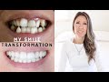 My Smile Transformation | Invisalign + HiSmile Whitening