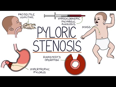 पाइलोरिक स्टेनोसिस को समझना