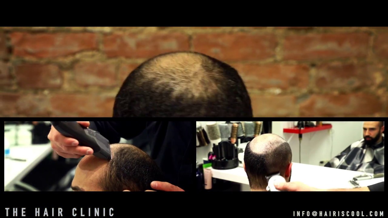The Non Surgical Hair Transplant Natural Hair Replacement System