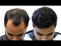 Reviving confidence 3000 grafts tackle grade 4 baldness at new roots hair clinic  hair transplant