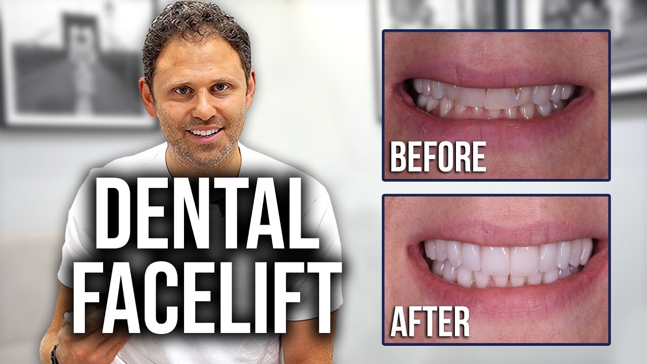 Using Porcelain Veneers To Give a Dental Facelift - Dental Science