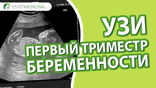 УЗИ первый триместр беременности (УЗИ 11 недель).  ✨🤰🏻 Храмченко Н.В.