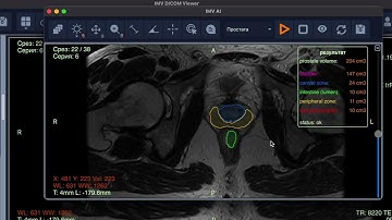 IMV PIRADS v1: AI-Powered Prostate Volume Estimation for IMV DICOM Viewer
