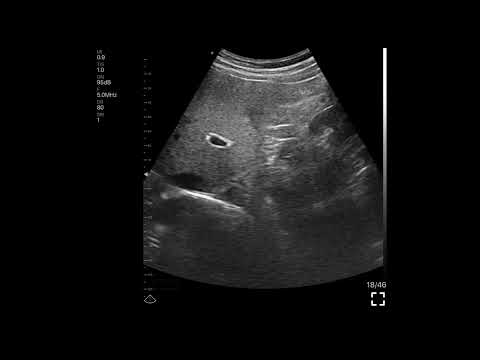 Liver and kidney · B-mode · C5SH · 5 MHz scan preview