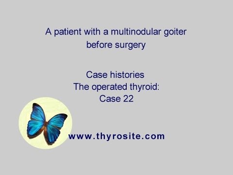 Multi goiter thyroid