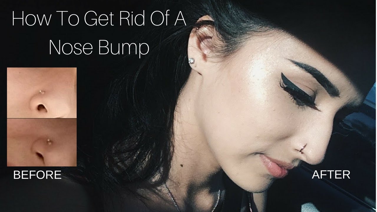 How To Get Rid Of A Keloid On Nose Piercing With Tea Tree Oil