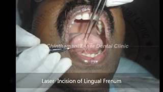 Thumbnail of Laser Treatment For Tongue Tie in Chennai,India