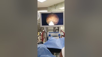 Botox injection for neurogenic bladder