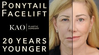 20 YEARS YOUNGER? Ponytail Facelift Before And After  Lip Lift, KaOgee Jowl Lift, Massai Neck Lift