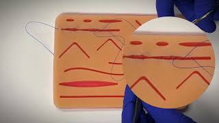 The Running Subcuticular Suture: Technique & Application Explained