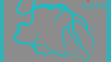 CTO - Chronic total occlusion angioplasty