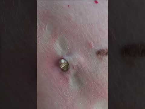 Big Cystic Acne Blackheads Extraction Blackheads & Milia, Whiteheads Removal Pimple Popping